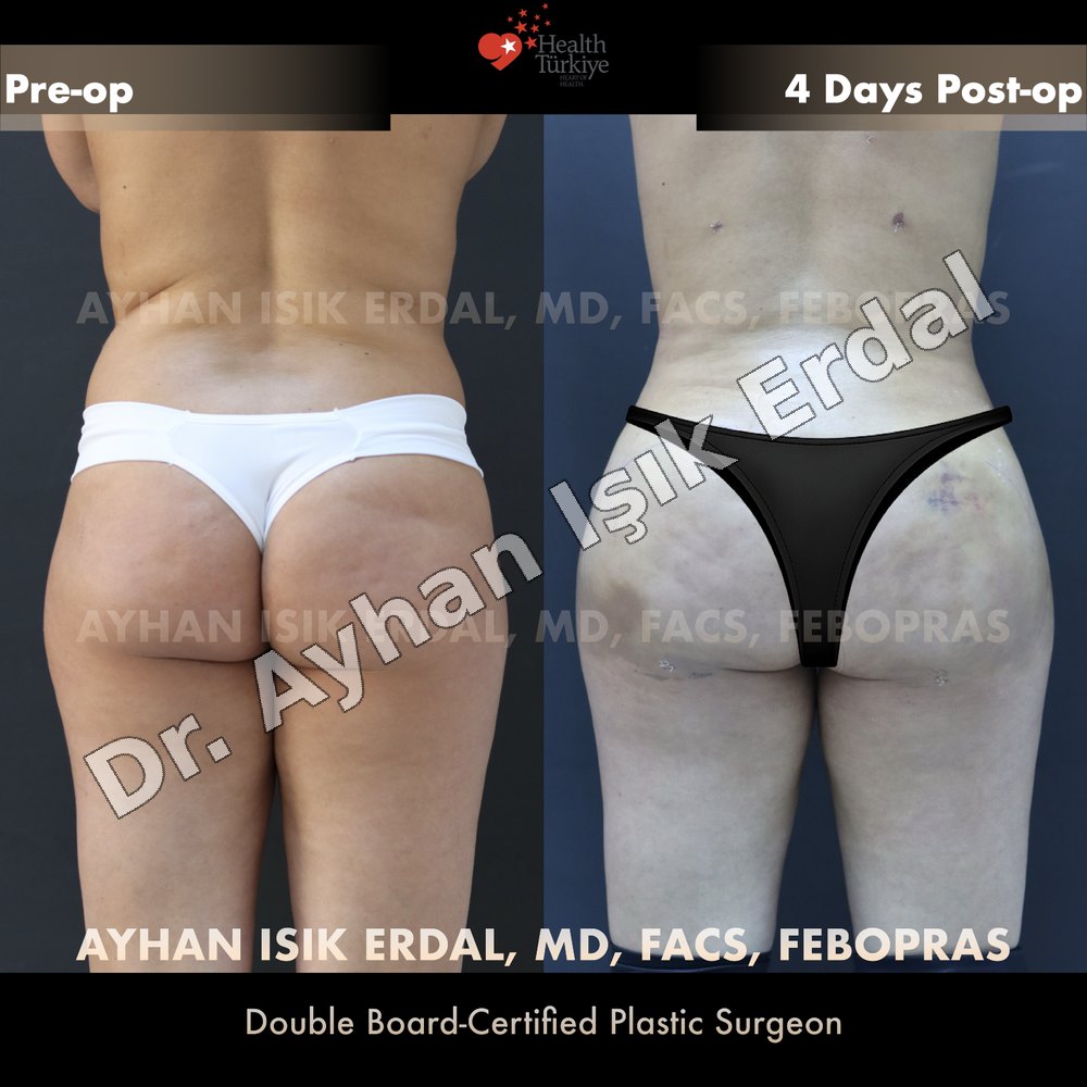 Brazilian Butt Lift (BBL) before-and-after result by Dr. Ayhan Işık Erdal, Istanbul