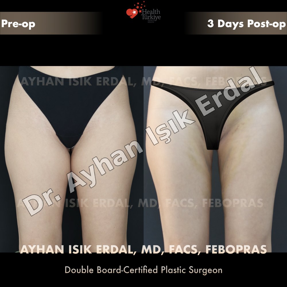 Brazilian Butt Lift (BBL) before-and-after result by Dr. Ayhan Işık Erdal, Istanbul
