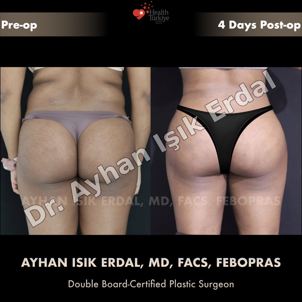 Brazilian Butt Lift (BBL) before-and-after result by Dr. Ayhan Işık Erdal, Istanbul