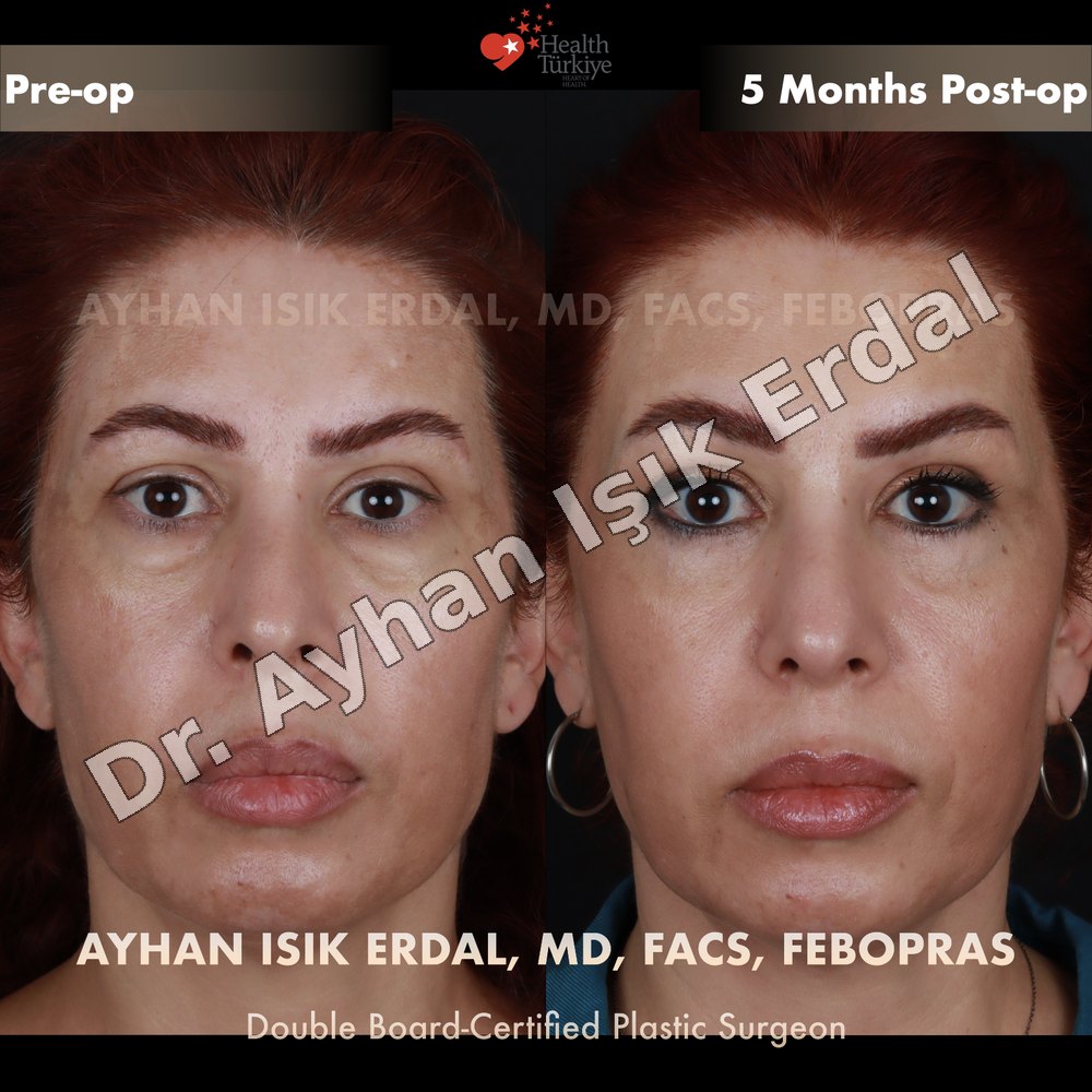 Blepharoplasty before-and-after result by Dr. Ayhan Işık Erdal, Istanbul
