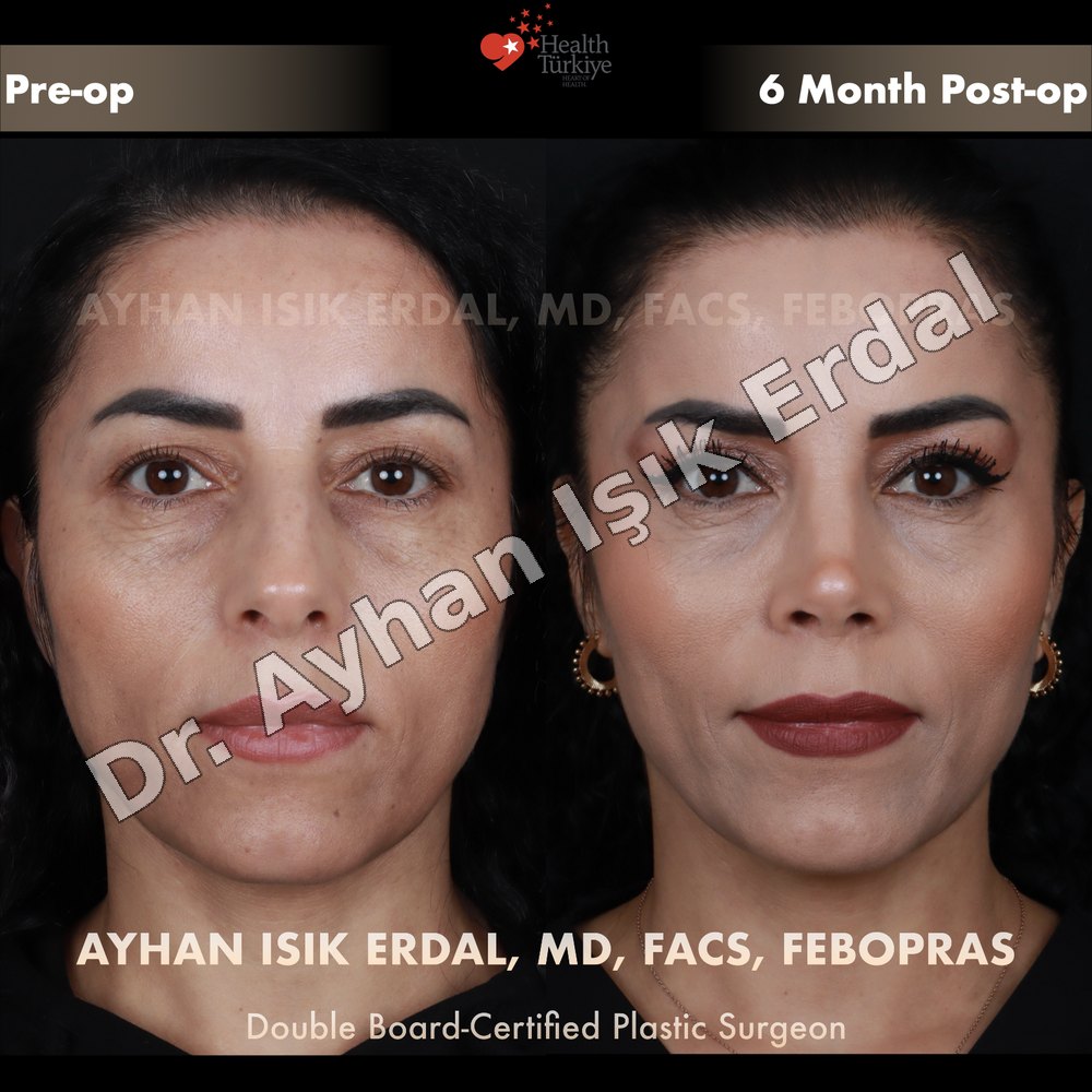 Blepharoplasty before-and-after result by Dr. Ayhan Işık Erdal, Istanbul
