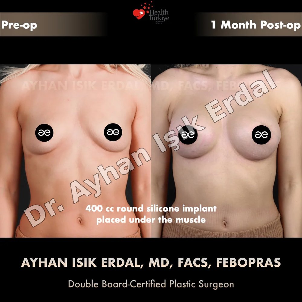 Breast Augmentation before-and-after result by Dr. Ayhan Işık Erdal, Istanbul