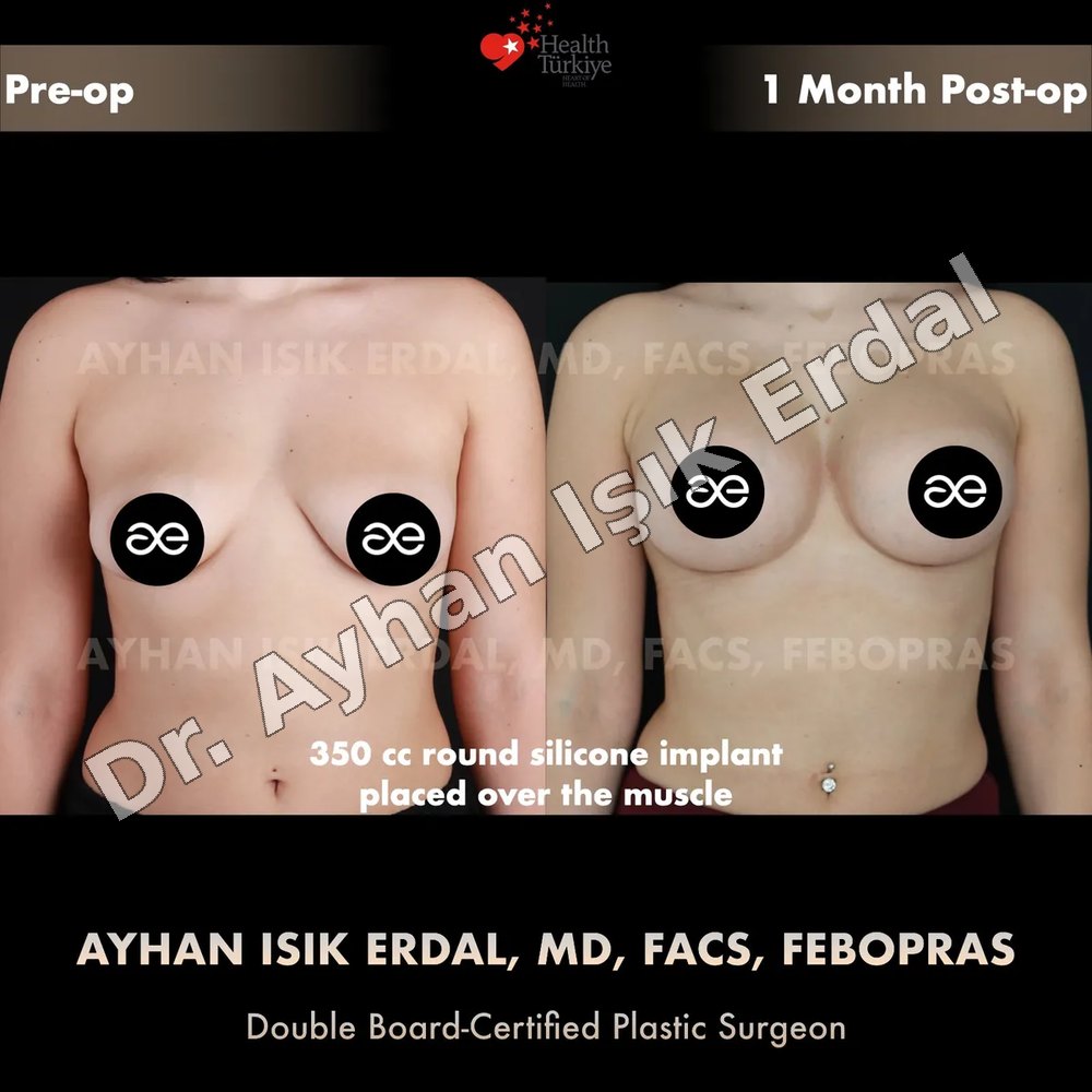 Breast Augmentation before-and-after result by Dr. Ayhan Işık Erdal, Istanbul