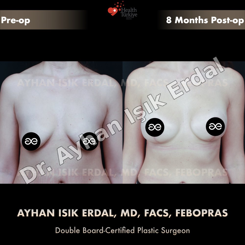 Breast Lift before-and-after result by Dr. Ayhan Işık Erdal, Istanbul
