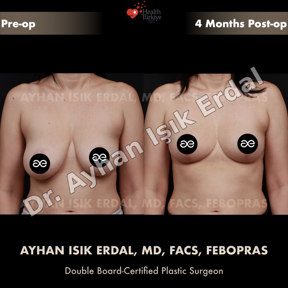 Breast Reduction before-and-after result by Dr. Ayhan Işık Erdal, Istanbul