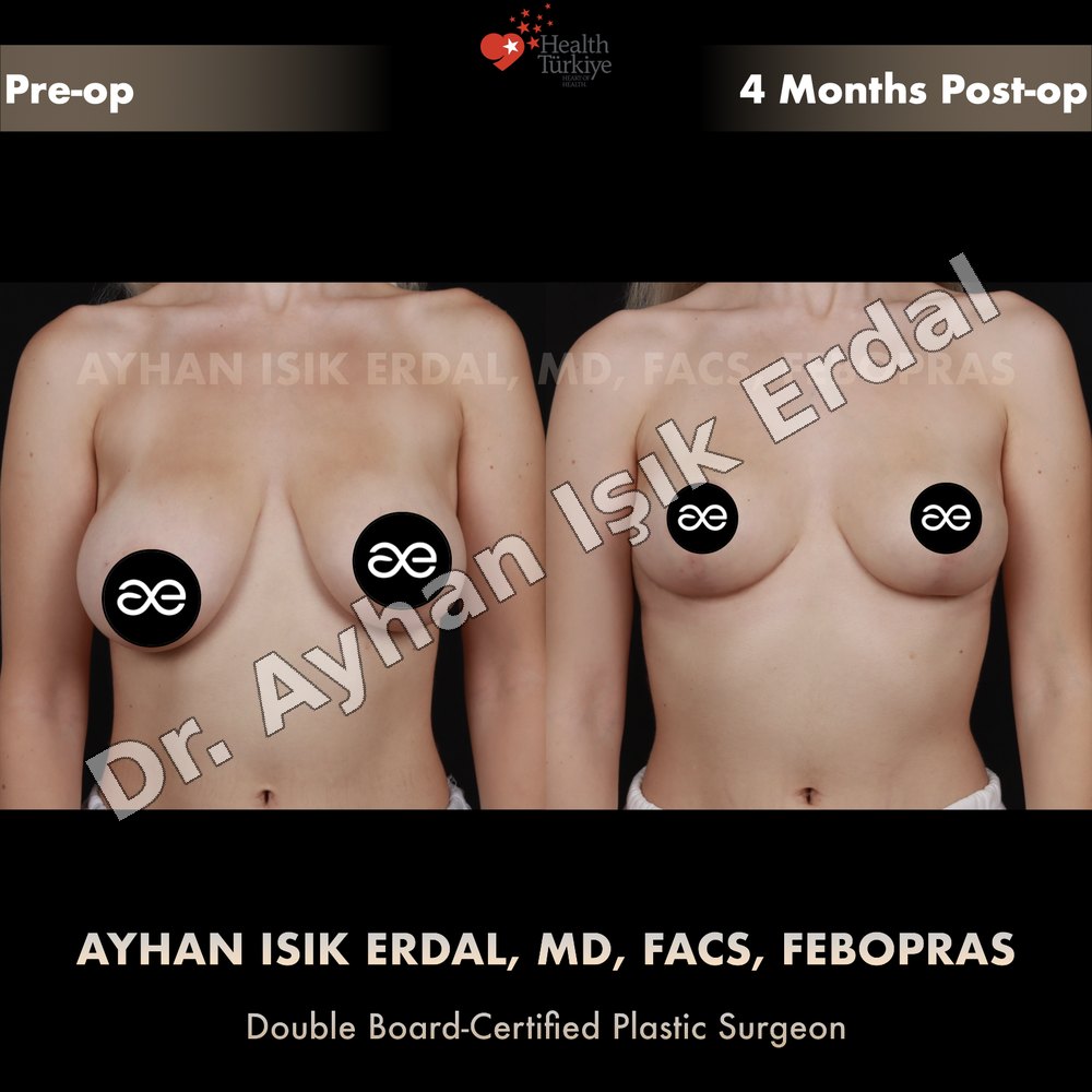 Breast Reduction before-and-after result by Dr. Ayhan Işık Erdal, Istanbul