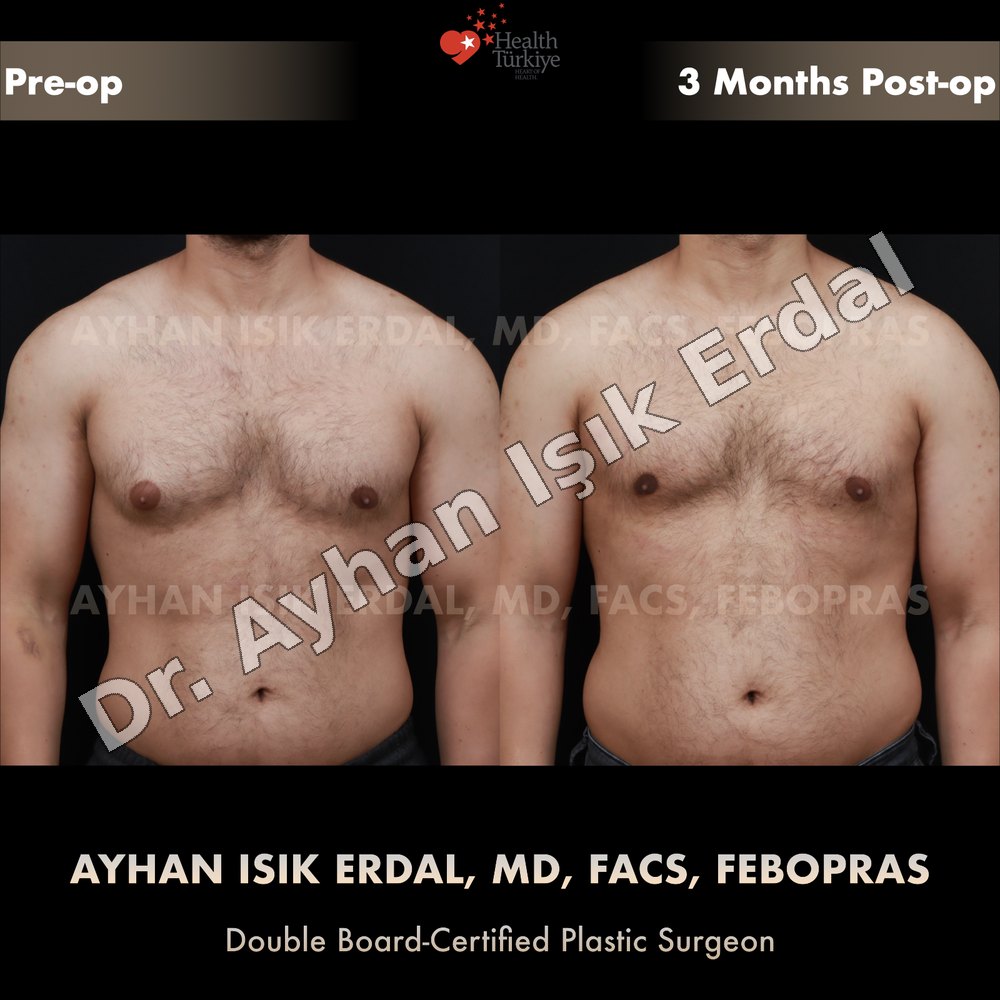 Gynecomastia before-and-after result by Dr. Ayhan Işık Erdal, Istanbul