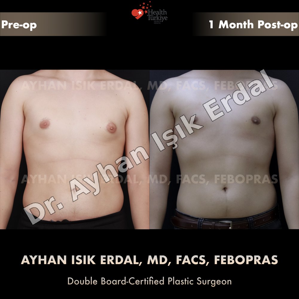 Gynecomastia before-and-after result by Dr. Ayhan Işık Erdal, Istanbul