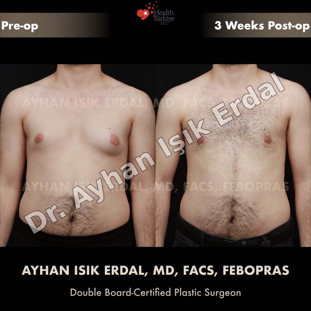 Gynecomastia before-and-after result by Dr. Ayhan Işık Erdal, Istanbul