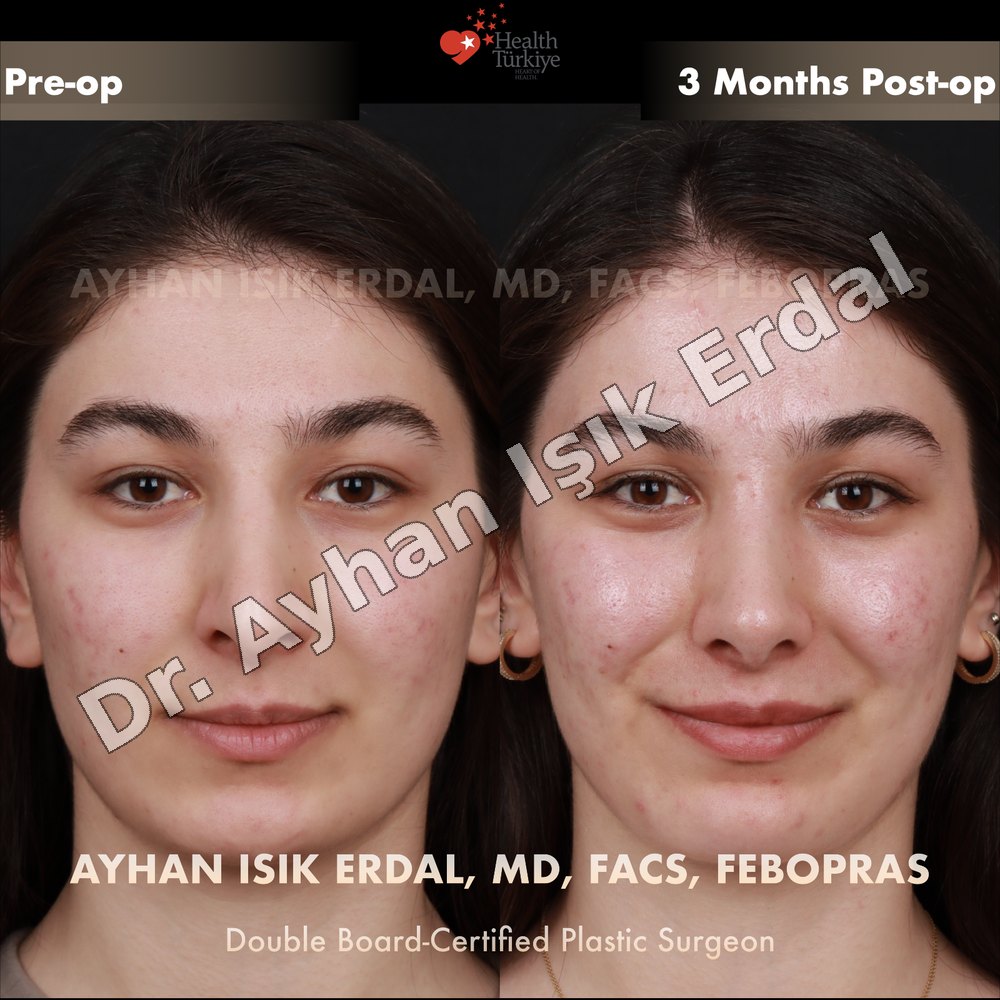 Revision Rhinoplasty before-and-after result by Dr. Ayhan Işık Erdal, Istanbul