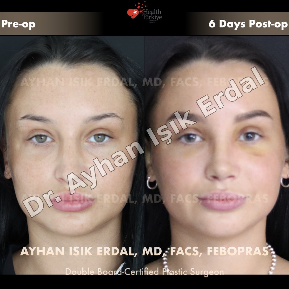 Revision Rhinoplasty before-and-after result by Dr. Ayhan Işık Erdal, Istanbul