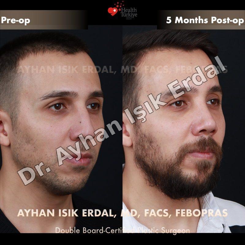 Rhinoplasty before-and-after result by Dr. Ayhan Işık Erdal, Istanbul