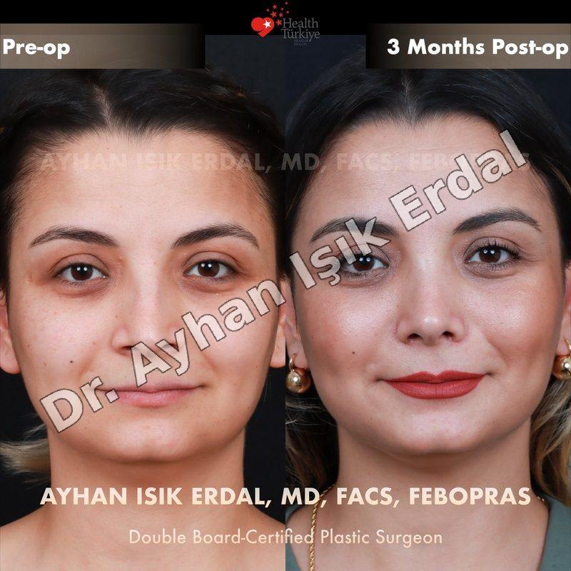 Rhinoplasty before-and-after result by Dr. Ayhan Işık Erdal, Istanbul