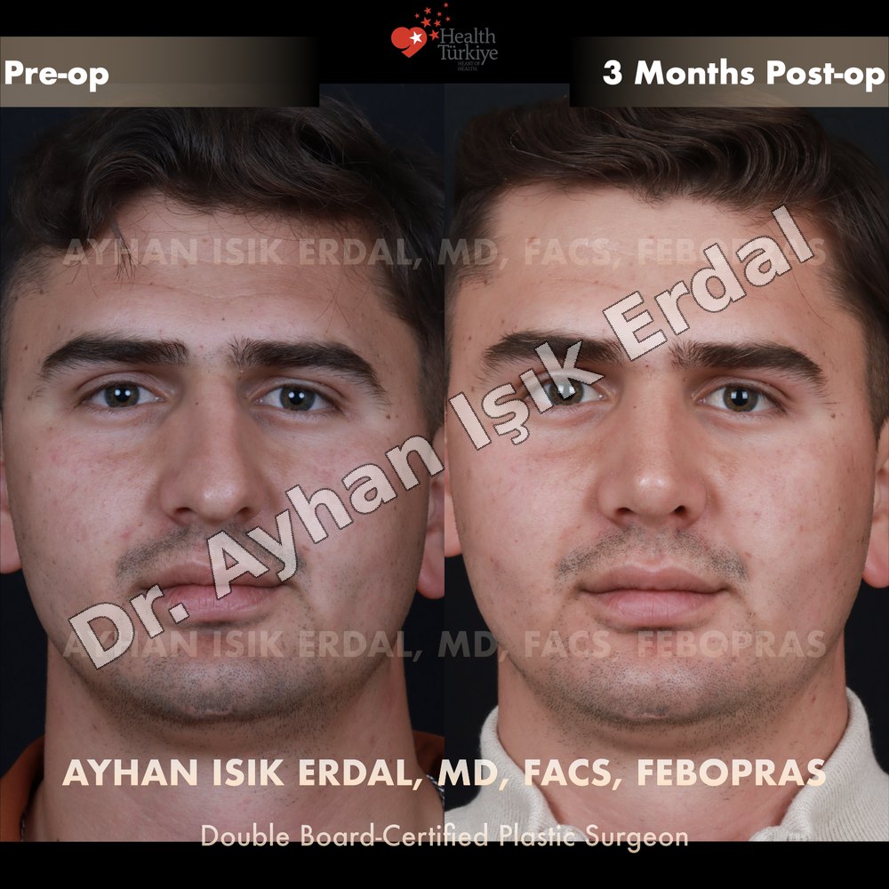 Rhinoplasty before-and-after result by Dr. Ayhan Işık Erdal, Istanbul