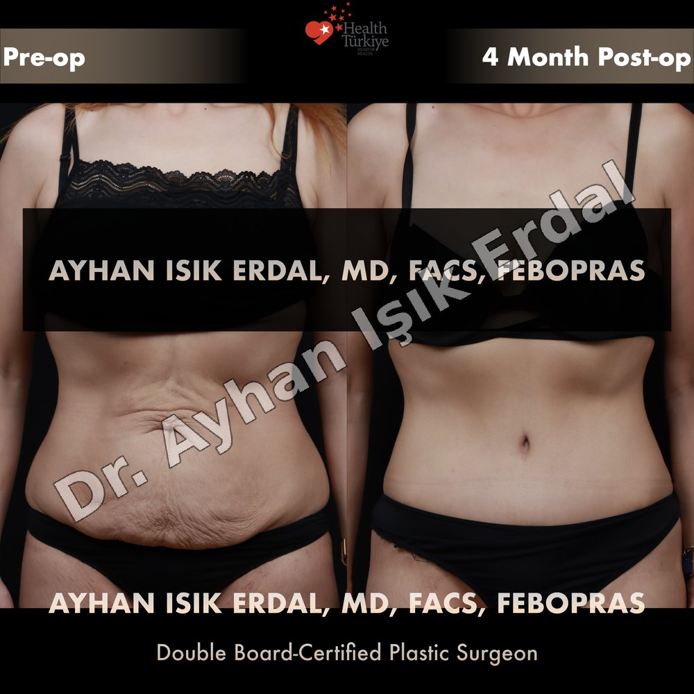 Tummy Tuck before-and-after result by Dr. Ayhan Işık Erdal, Istanbul